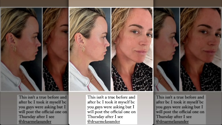 Teddi Mellencamp showcasing neck lift 