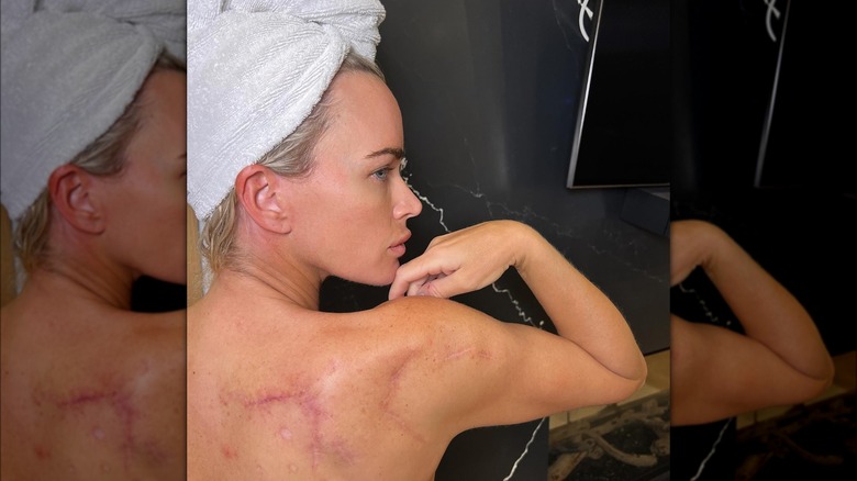 Teddi Mellencamp with melanoma scars