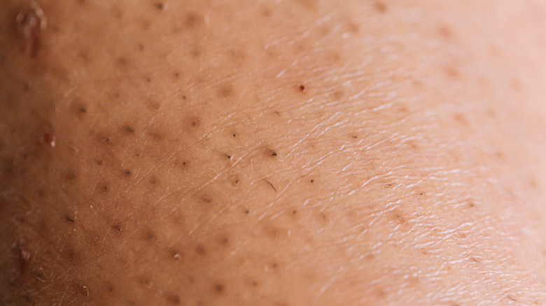 Ingrown hair on skin 