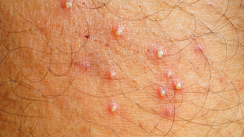 Folliculitis on skin 