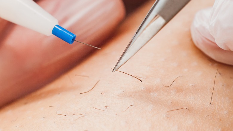 Electrolysis hair removal close up