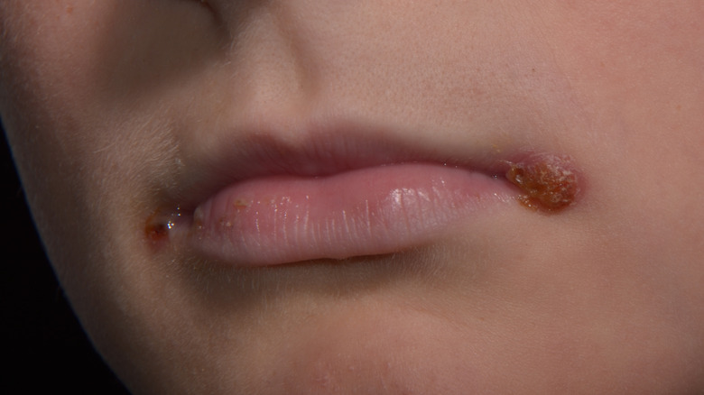 Angular cheilitis mouth