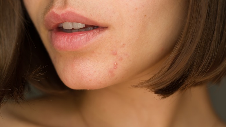 Woman's face with pimples on jawline