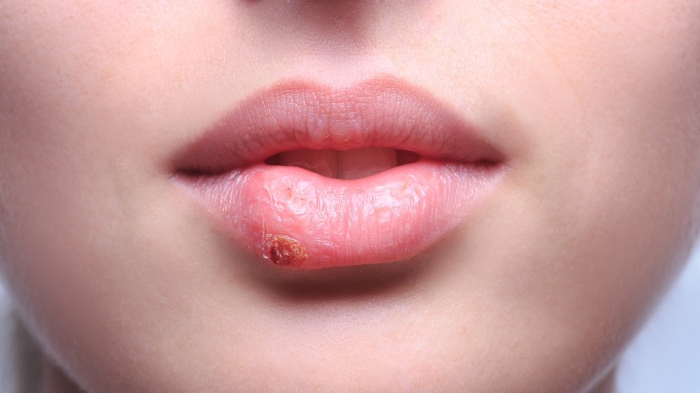  cold sore from kissing