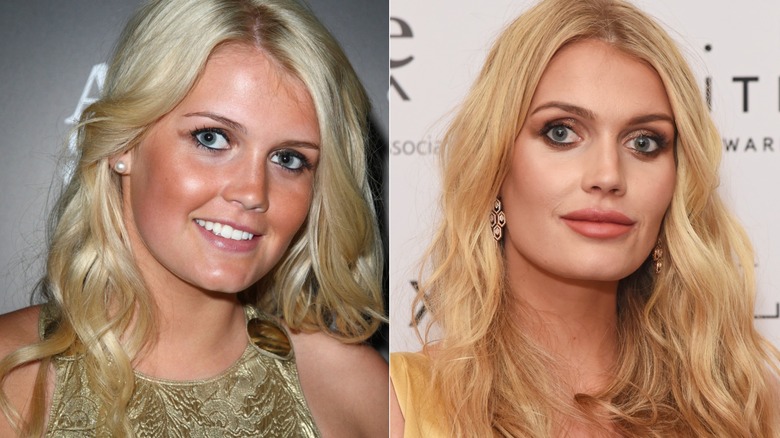 Close-ups of Kitty Spencer smiling from before and after alleged cosmetic procedures