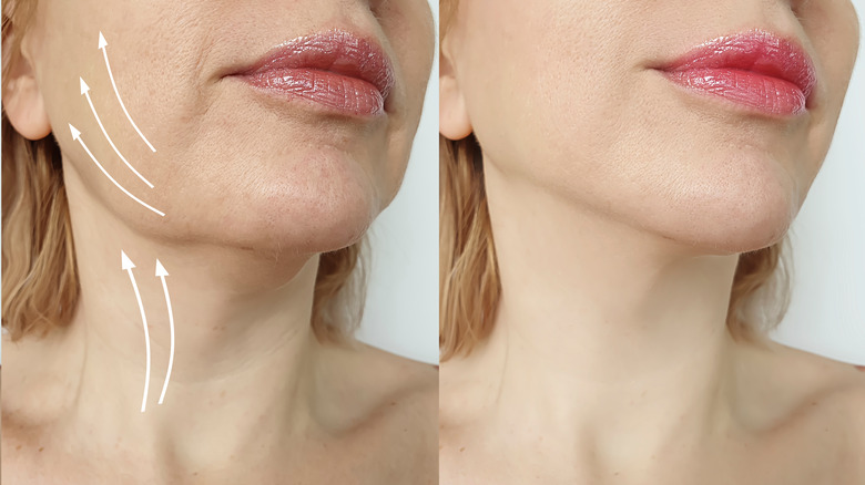 Jowls before, after face-lift