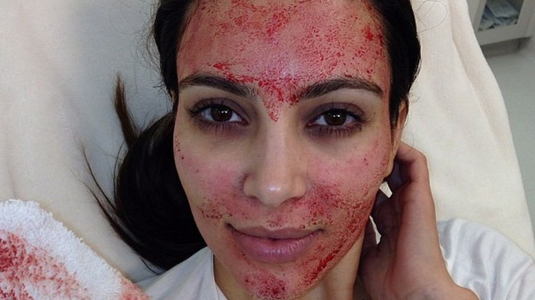 Kim Kardashian blood facial