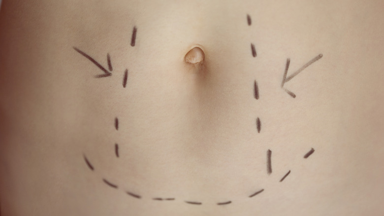 Surgical markings on tummy