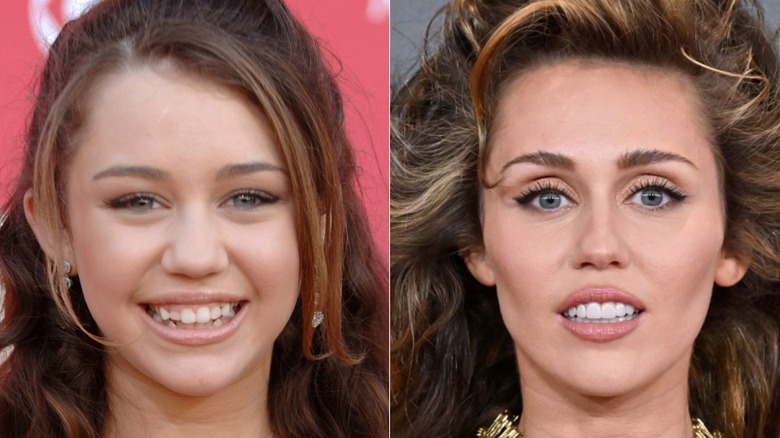 (L) Miley Cyrus smiling (R) Miley Cyrus showing new teeth with her tongue out