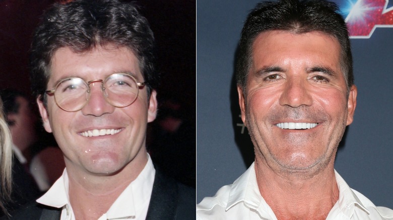 Simon Cowell smile before and after