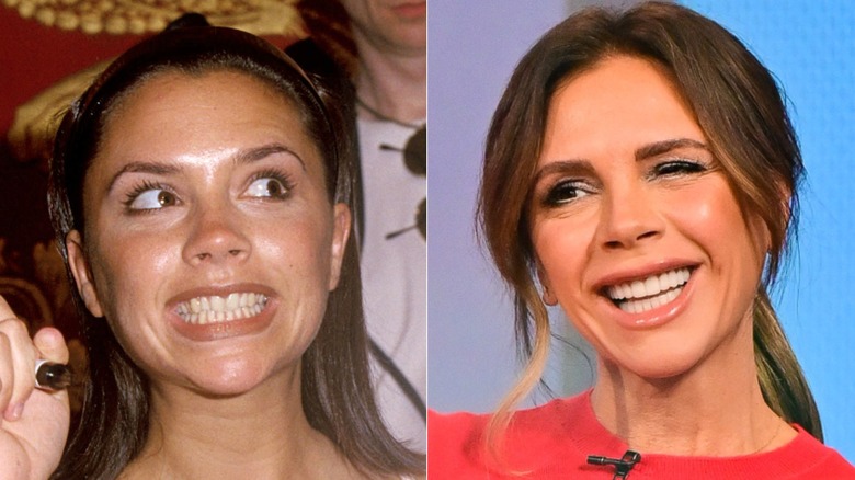 (L) Young Victoria Beckham with teeth showing (R) Victoria Beckham smiling