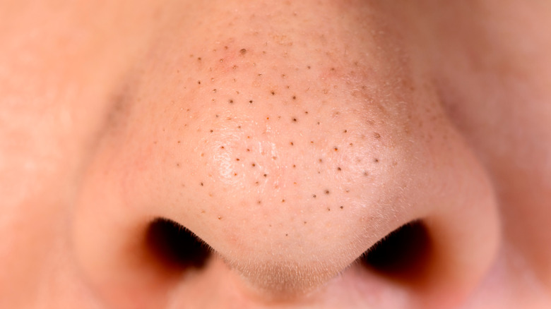 Up-close image of blackheads on nose