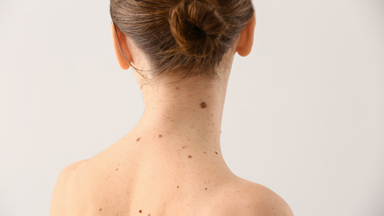 moles on a woman's back