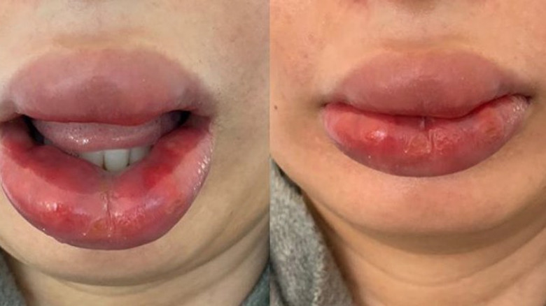Botched lip injection aftermath