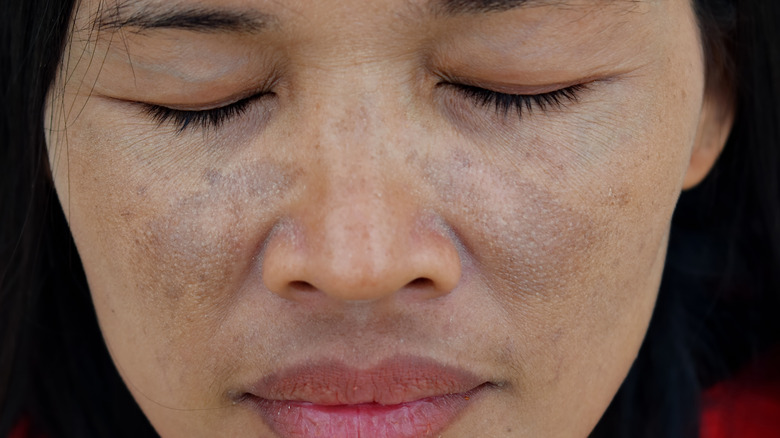 Woman with melasma