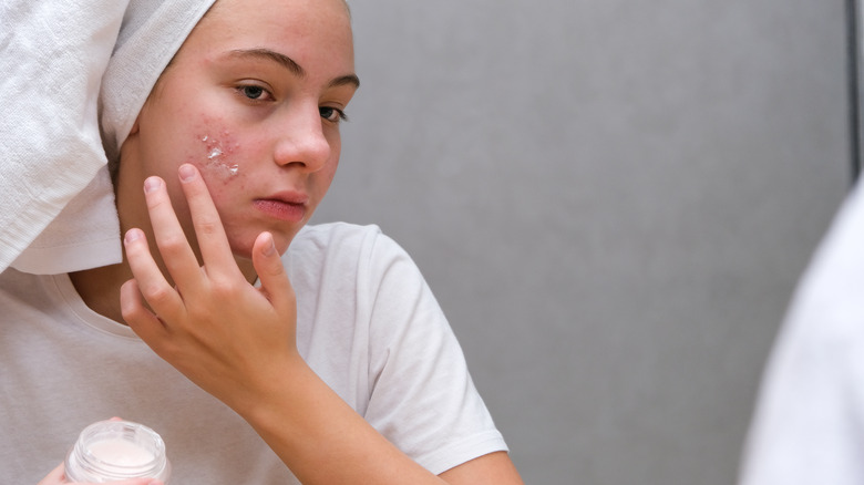 girl putting product on her acne