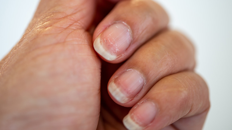 Can Eczema Cause Nail Pitting Bios Pics