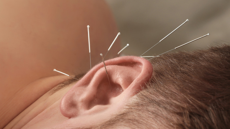 man with acupuncture needles in his ear.