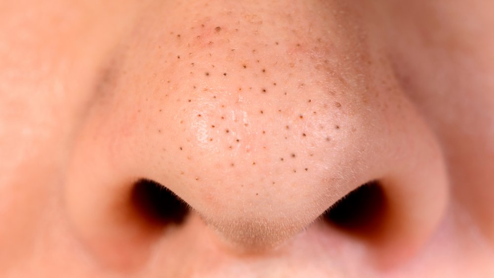 a nose with blackheads