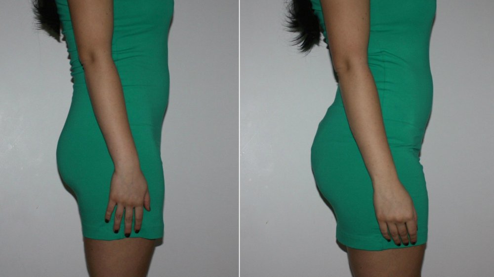 before and after photos, brazilian butt lifts