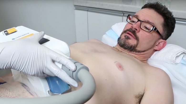 A man getting CoolSculpting on his abdomen