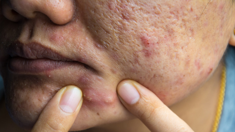 Woman with cystic acne and acne scars