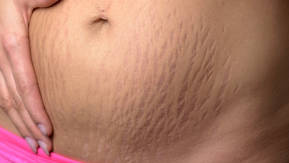 pregnancy stretch marks