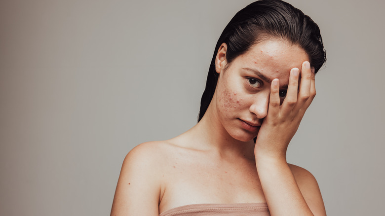 Acne can cause emotional discomfort