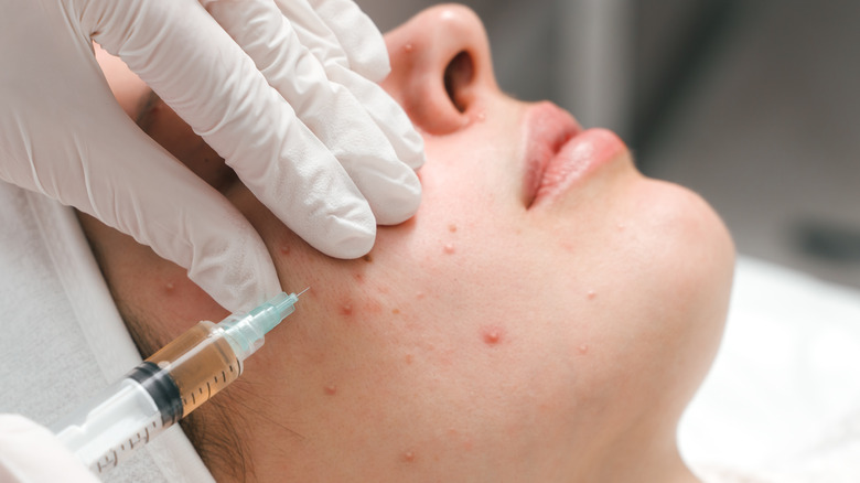 Treating acne with injections