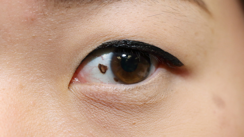 Eye birthmark