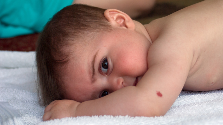 Baby with birthmark