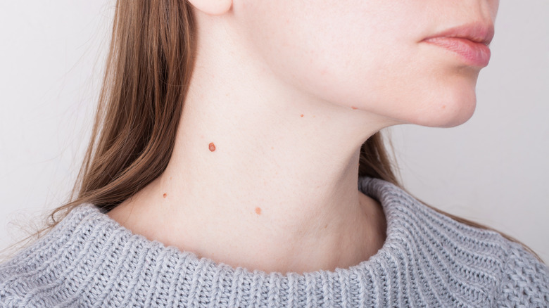 Birthmark on neck