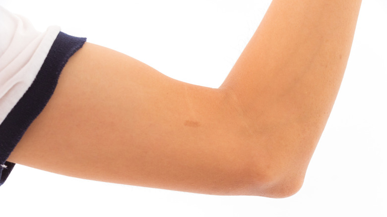 Birthmark on arm