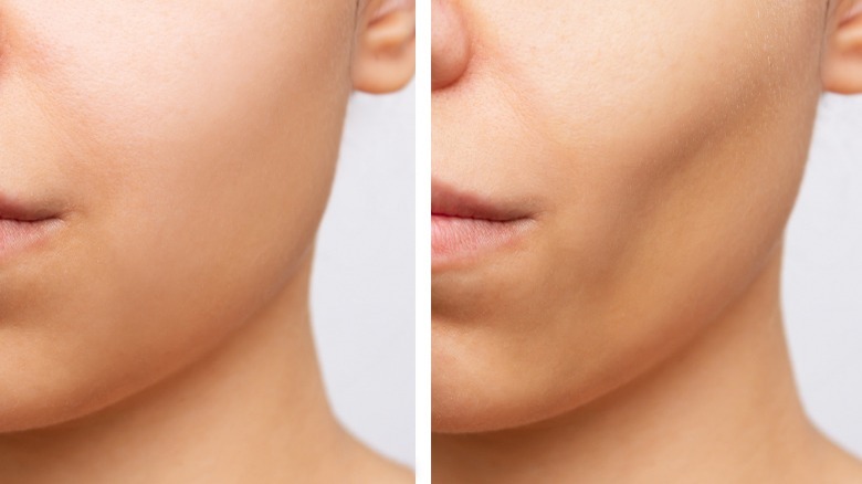 Before / after buccal fat removal 