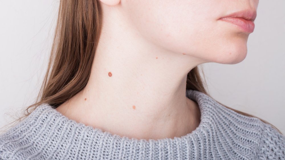 woman with birthmarks on neck