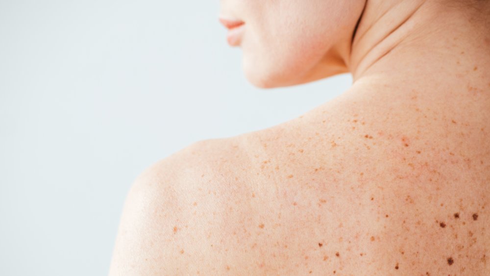 woman with birthmarks on back