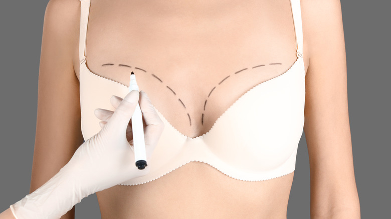 doctor marking breasts for surgery