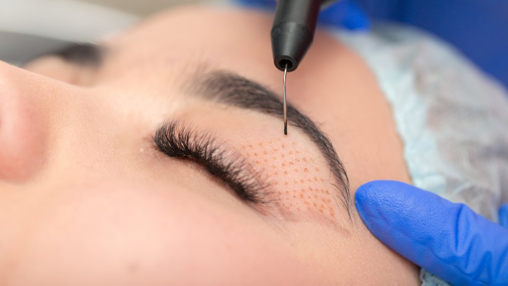 A cosmetic procedure being performed on a person's eyelid 