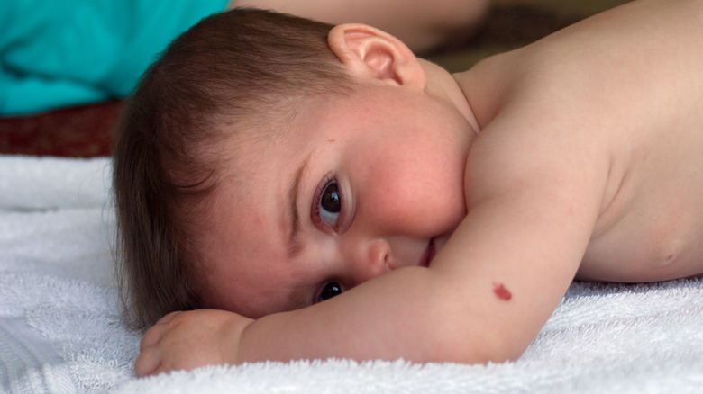 Baby with birthmark