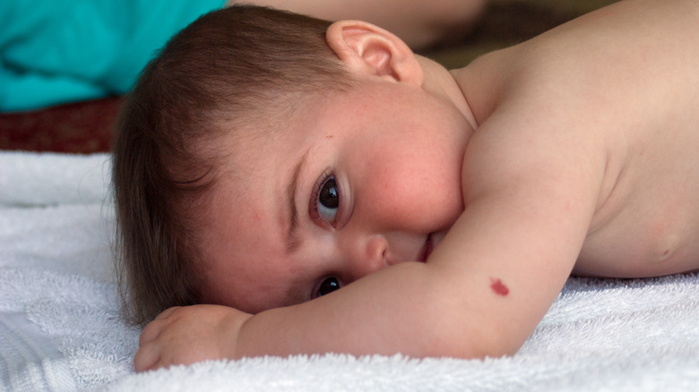 baby with birthmark