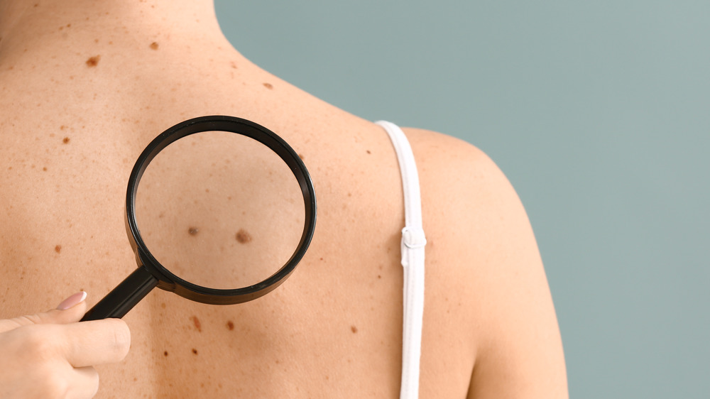 Hand holding magnifying glass over moles on a person's back 