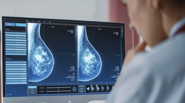 A doctor looking at a breast scan 