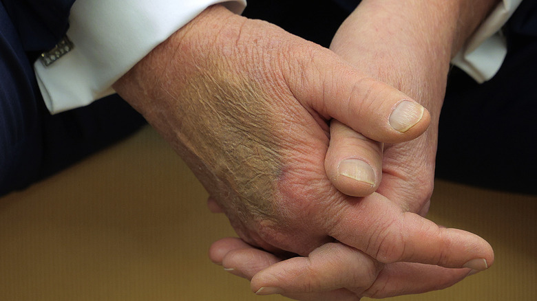 Donald Trump's bruised hand and ridged nails