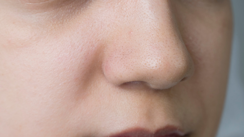 woman with blackheads on nose