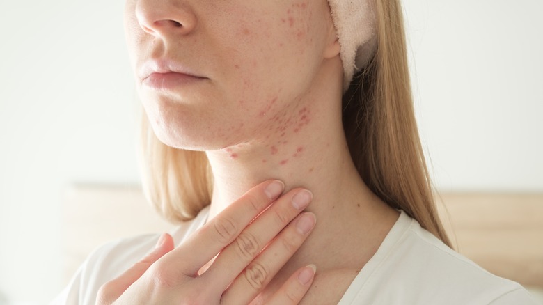 woman with neck cystic acne