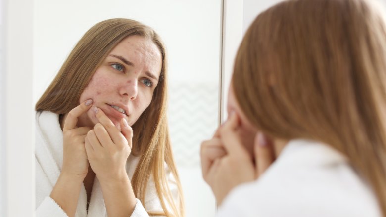 young woman with adult acne