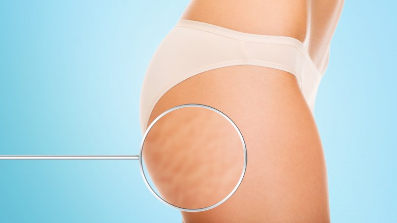 close up image of cellulite