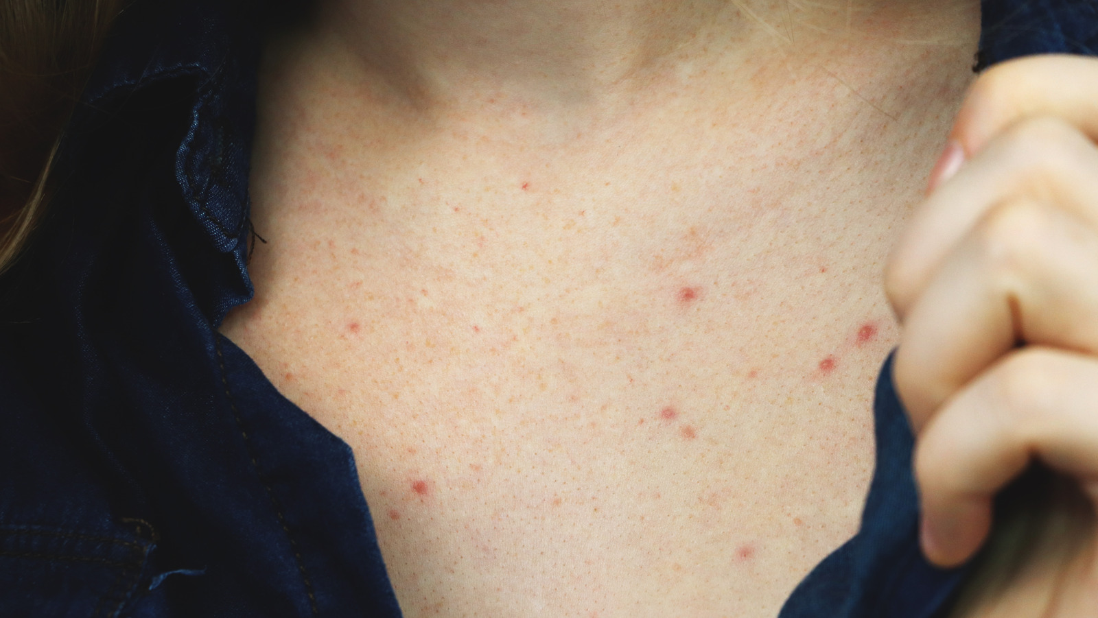 What Are Sweat Pimples And How Do You Treat Them?