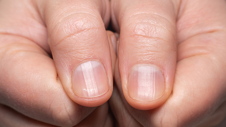 What's Causing That Black Line on Your Nail