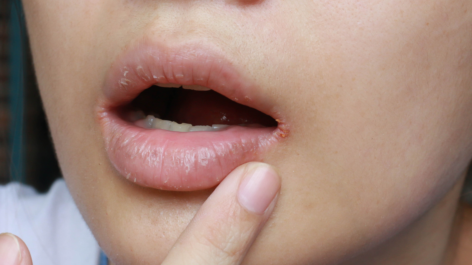 9-remedies-for-bumps-on-lips-to-treat-naturally-at-home-youtube